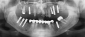 Rentgen snimak sa implantatima